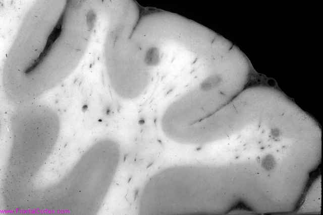 Arterial border zone infarcts between anterior and middle cerebral artery circulations